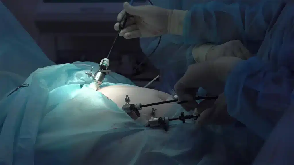 Beneficios de la cirugía laparoscópica Dr Jeilan Martinez Hoed