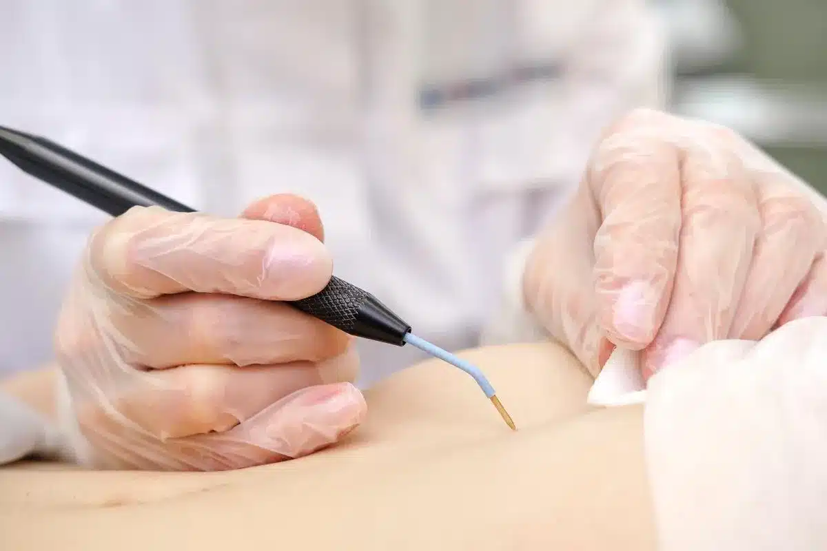 Crioterapias – Clínica Dra. Gisele Viana, image size:1200x800