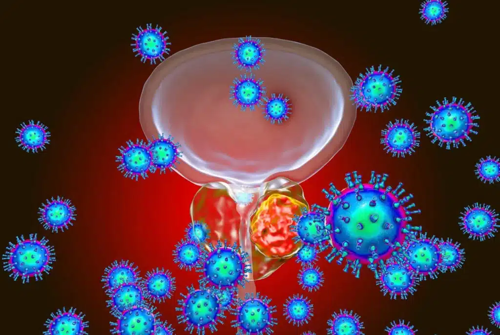 como tratar el cáncer de próstata en costa rica